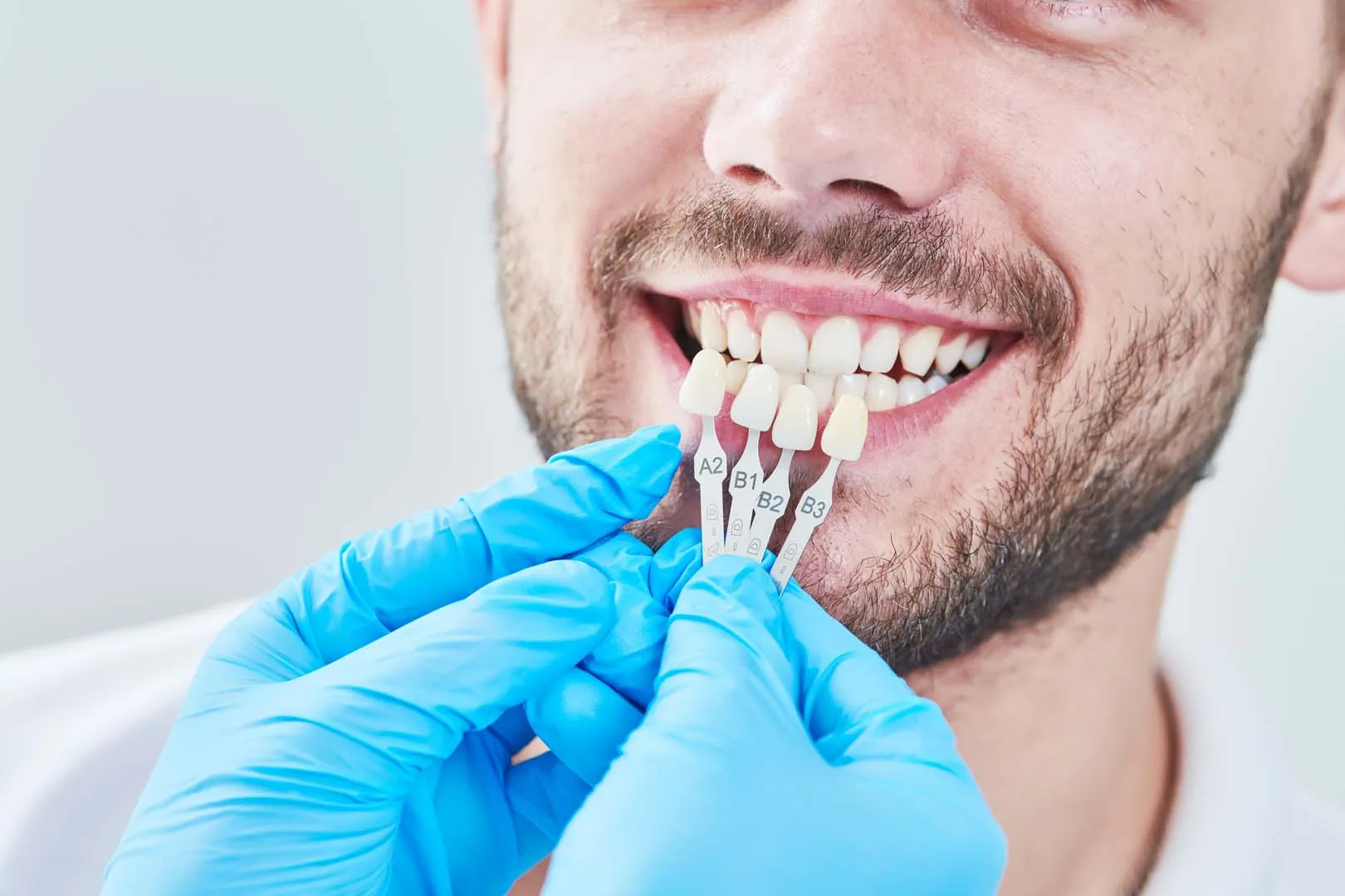 Porcelain Veneers at Anaheim Smile Center