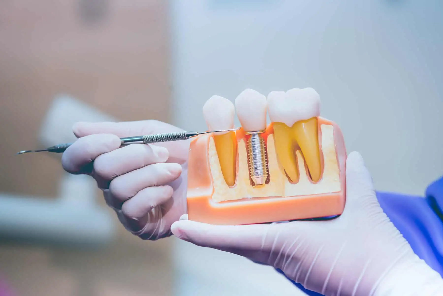 DENTAL IMPLANTS at Anaheim Smile Center
