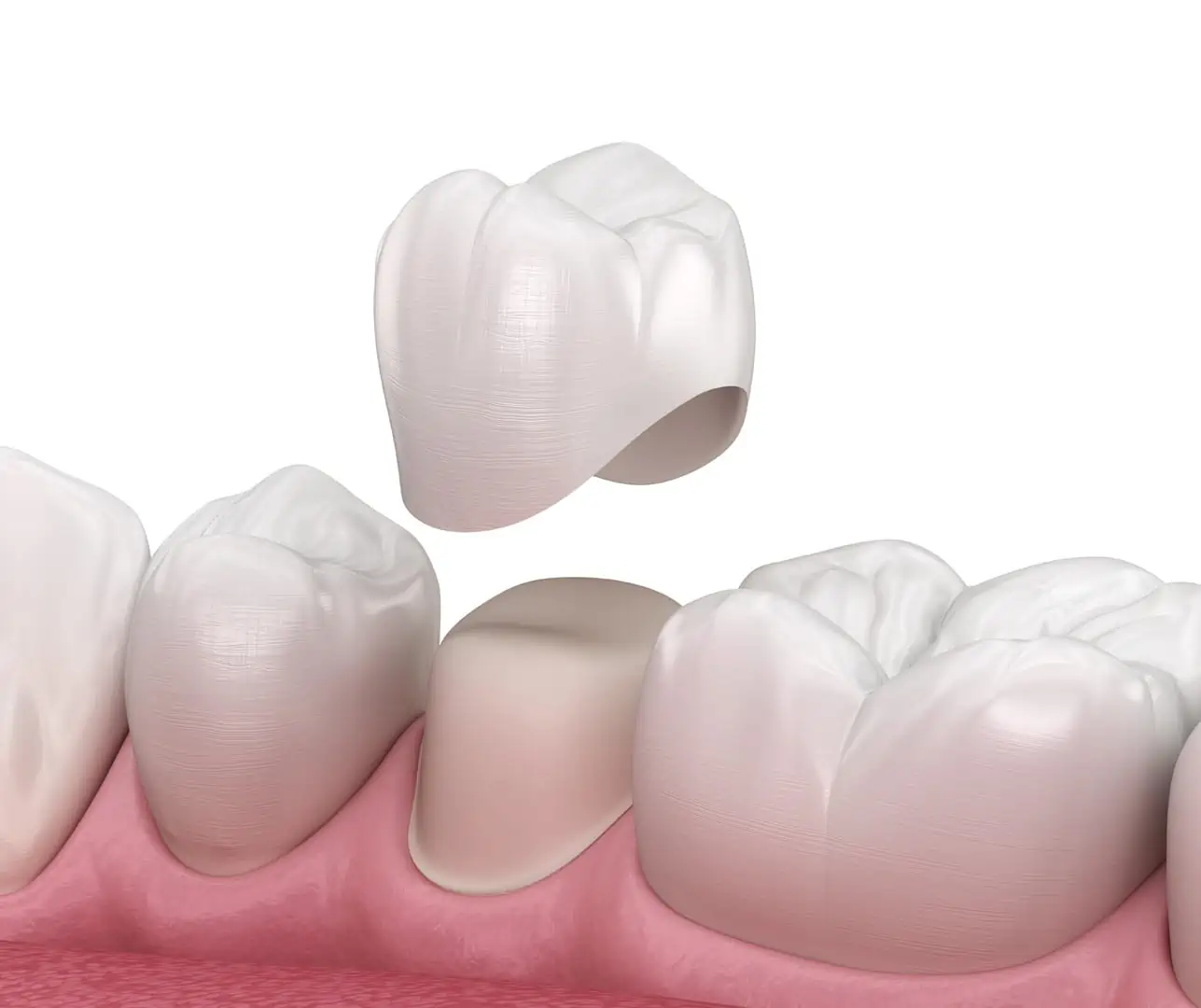 Restorative dentistry treatment at Anaheim Smile Center