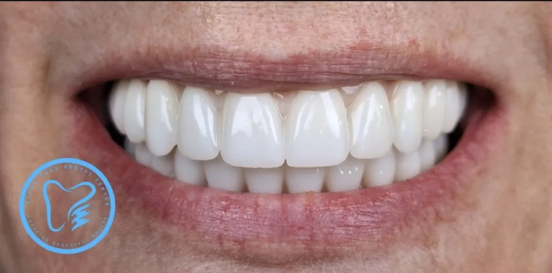 After dental treatment