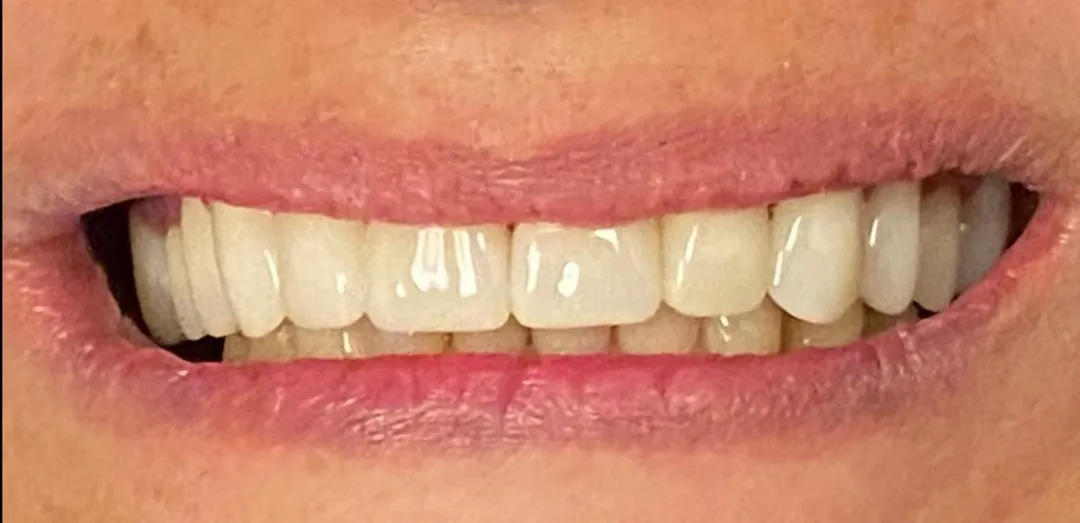 After dental treatment