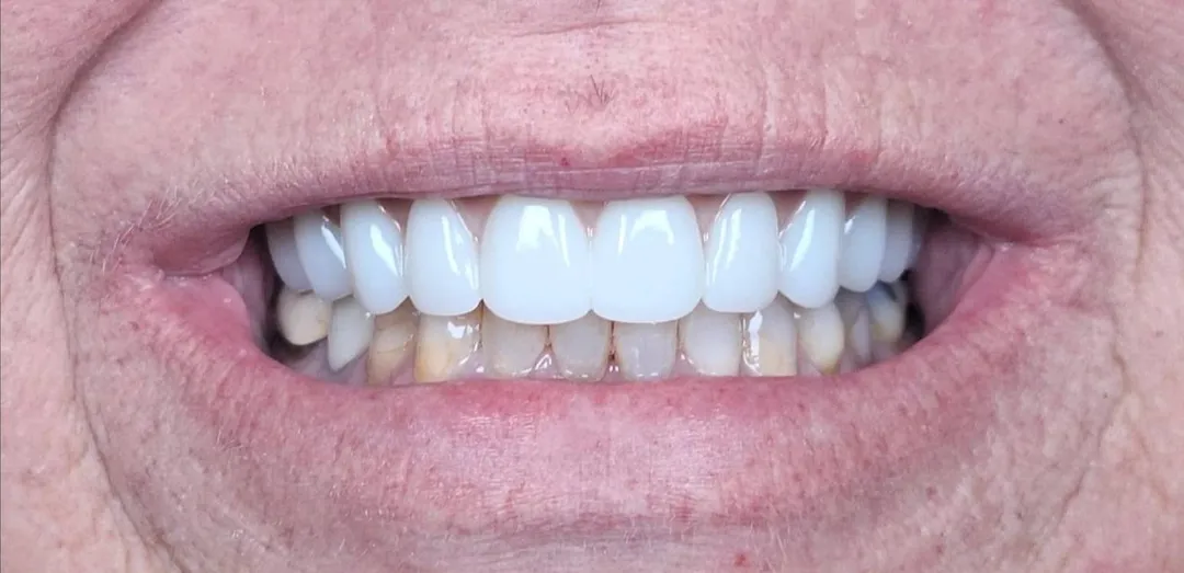 After dental treatment