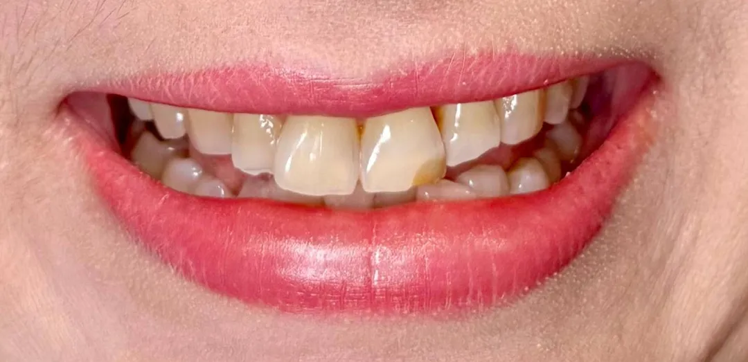 Before dental treatment