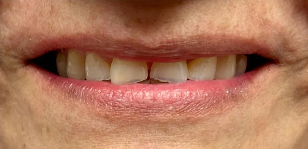 Before dental treatment