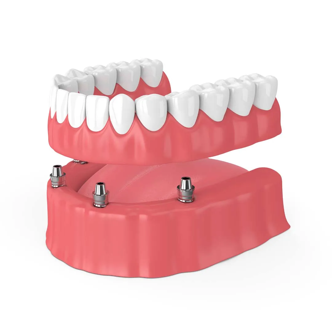 ALL-ON-4&reg; at Anaheim Smile Center