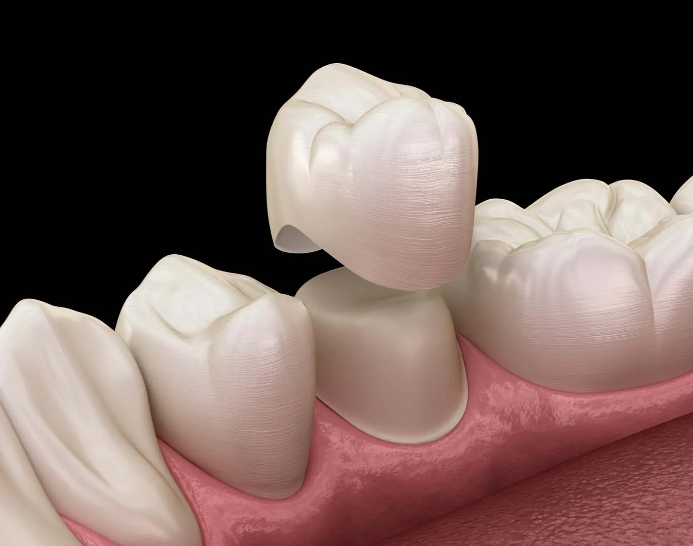 CROWNS at Anaheim Smile Center