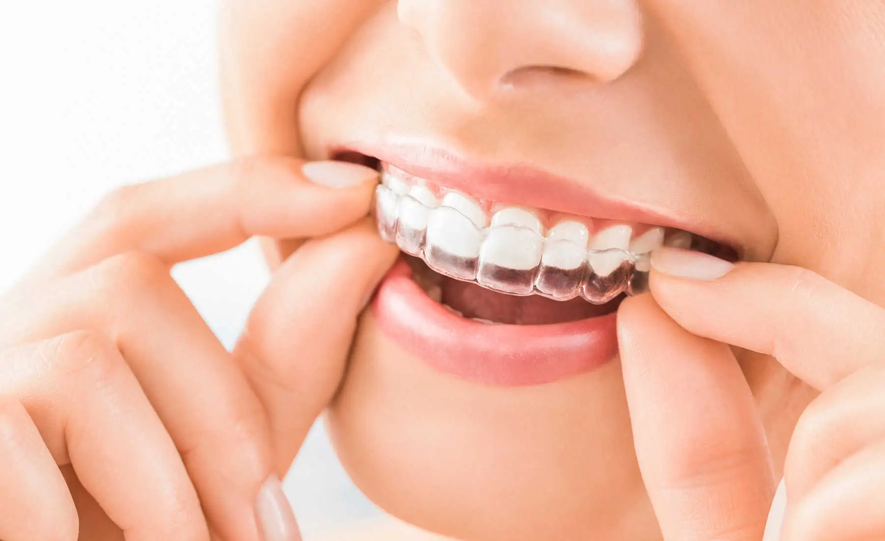 Invisalign at Anaheim Smile Center