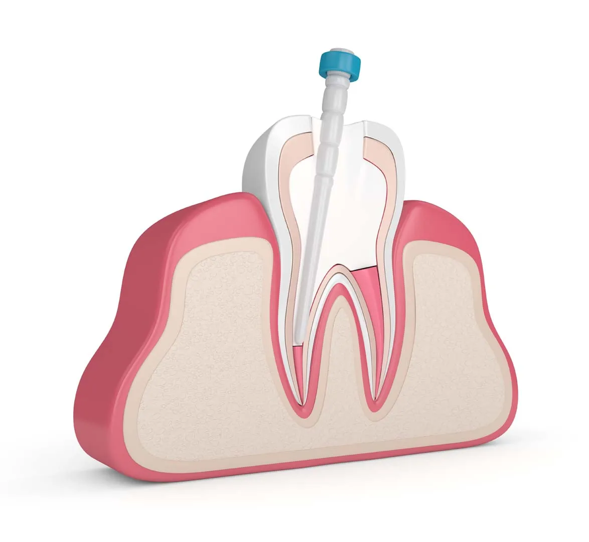 ROOT CANALS at Anaheim Smile Center