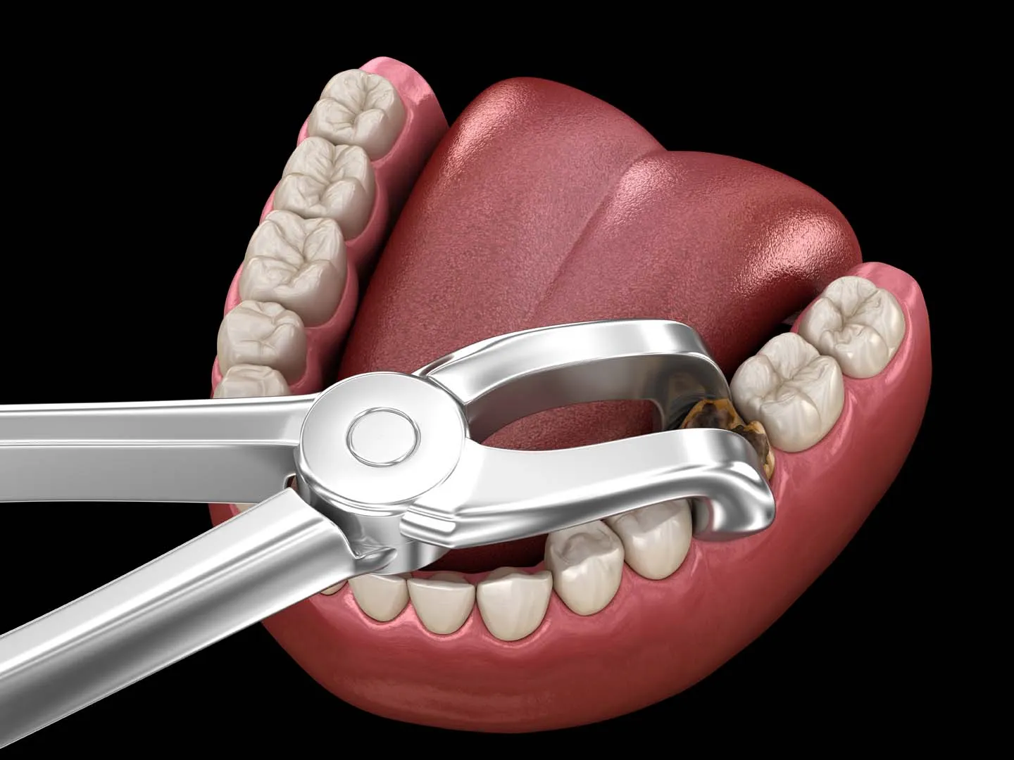 TOOTH EXTRACTIONS at Anaheim Smile Center